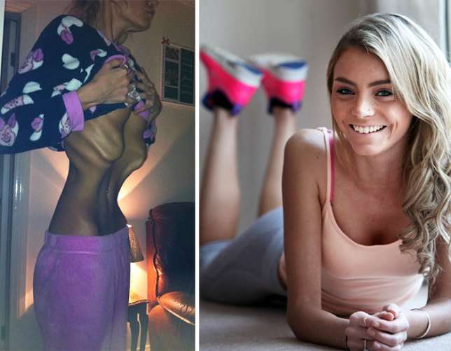30 людей, победивших анорексию: фото до и после