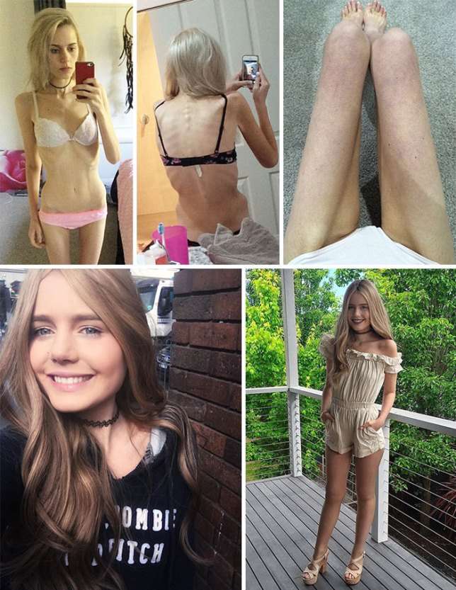 30 людей, победивших анорексию: фото до и после