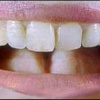 Найден ген, ответственный за рост зубов