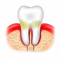 12 простых советов, которые помогут предупредить образование зубного камня