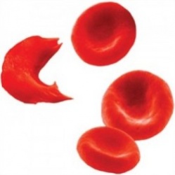 Всемирный день серповидноклеточной анемии