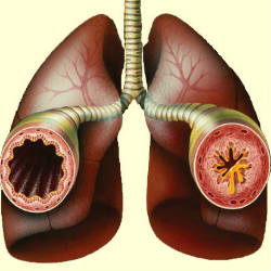 Бронхиальная астма и ее лечение