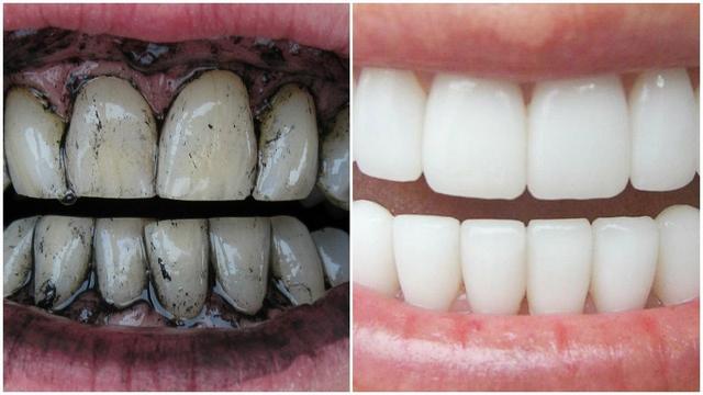 Белые зубы лечение дома thumbnail