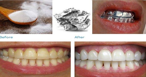 Лечение отбеливание зубов дома thumbnail