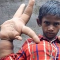 Мальчику с самыми большими в мире руками уменьшили правую конечность