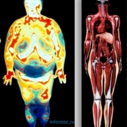 50 оттенков жира: о чем расскажут его отложения в разных частях тела и как с этим бороться
